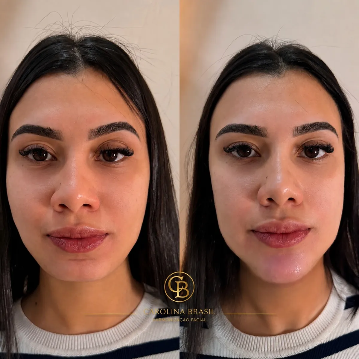 Antes e depois de harmonização facial, vista frontal.
