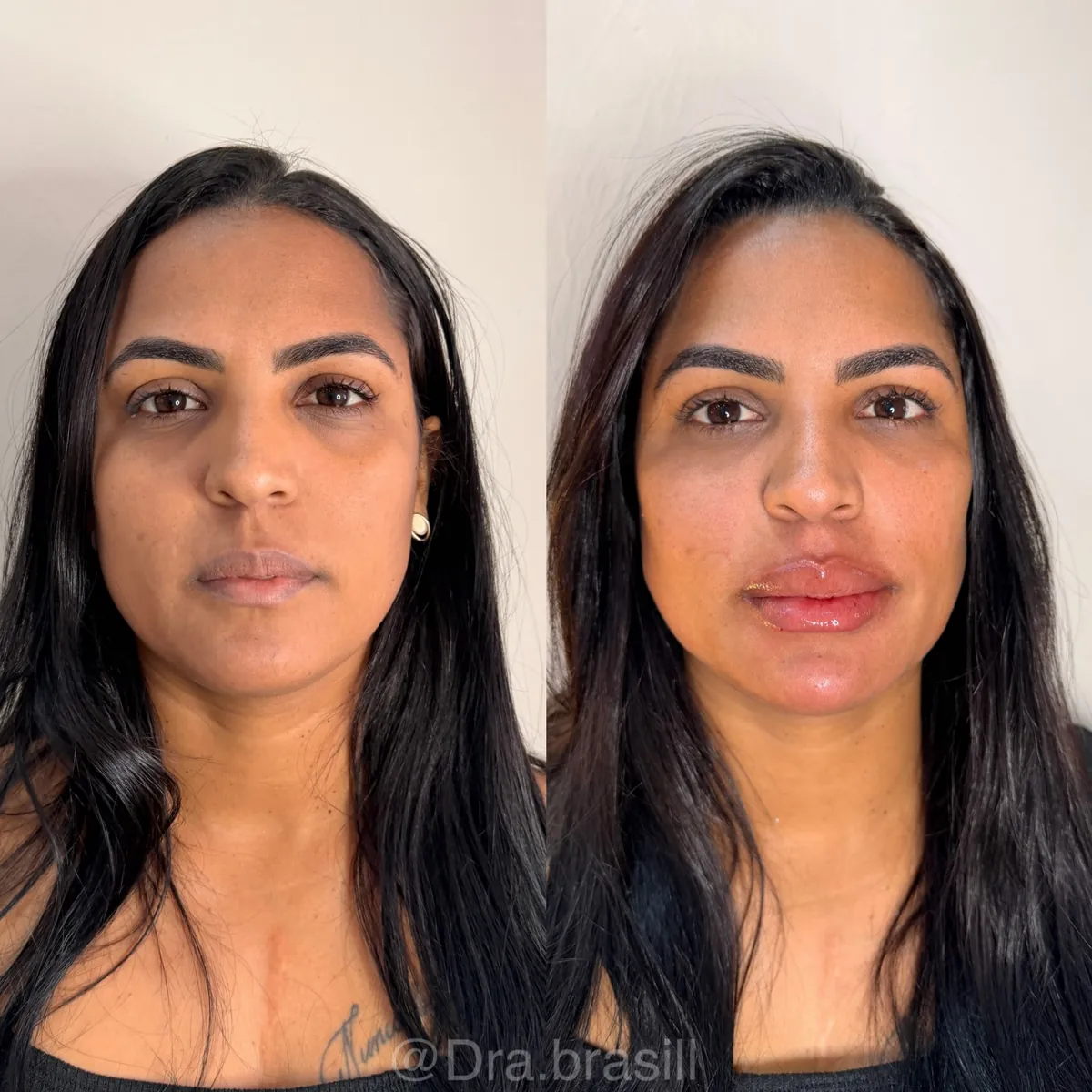 Antes e depois de preenchimento labial, vista frontal.