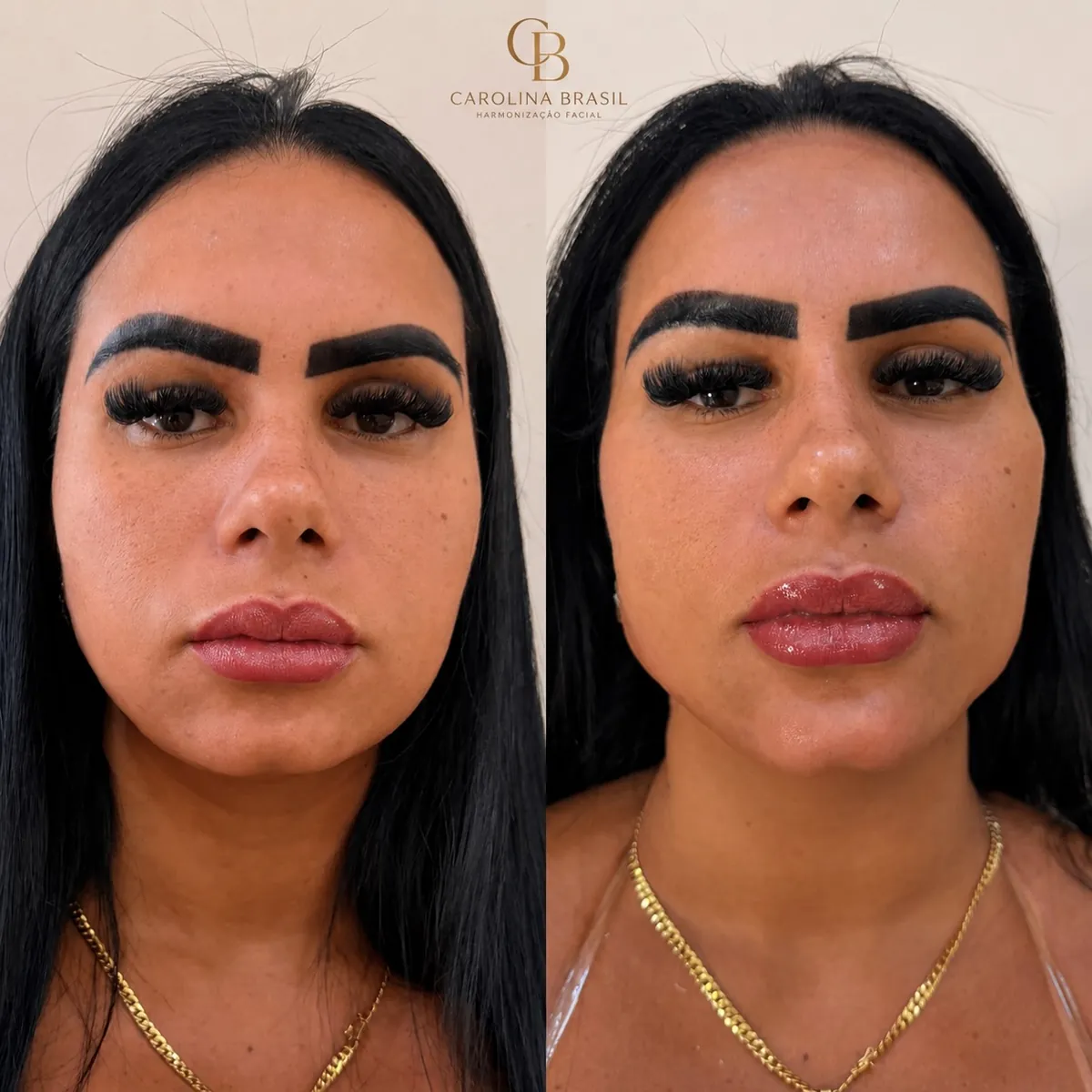 Antes e depois de preenchimento labial, vista frontal.