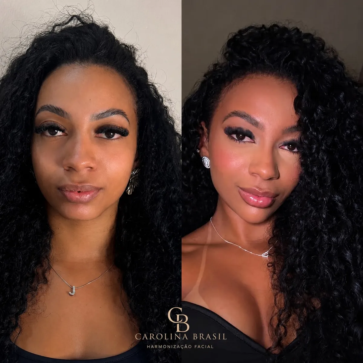 Antes e depois de preenchimento labial, com pele iluminada.