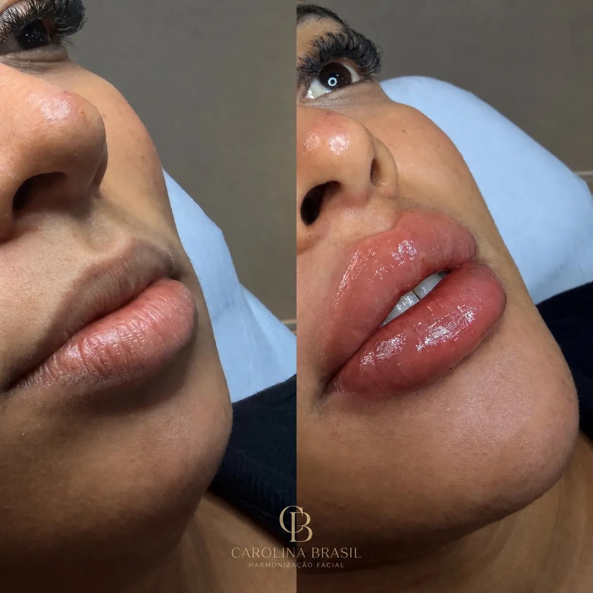 Antes e depois de preenchimento labial, vista de três quartos.