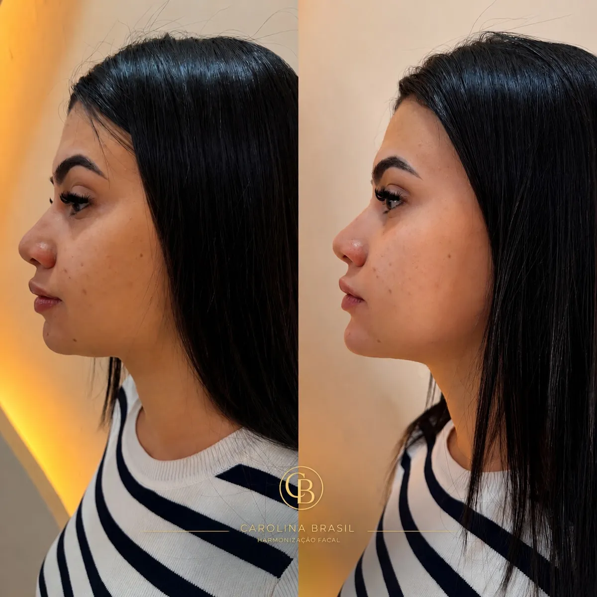 Antes e depois de contorno de perfil, vista lateral.